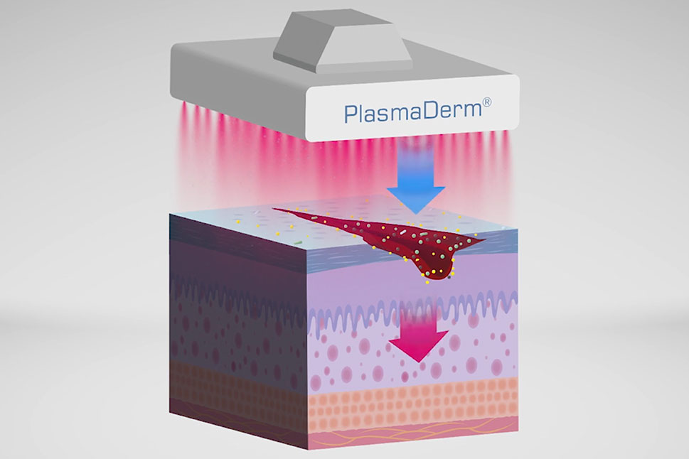 Die Grafik zeigt, wie aus der Wundauflage kaltes Plasma auf die verletzte Haut wirkt. Zunächst werden Keime an der Oberfläche abgetötet. Darüber hinaus stellt die Grafik ein elektromagnetisches Wechselfeld dar, welches auch in tiefere Hautschichten ei